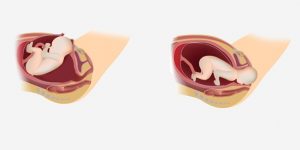 تصمیم گیری برای زایمان - زایمان طبیعی یا سزارین